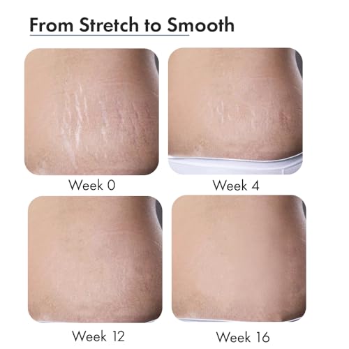ThriveCo 30ml Serum for New and Old Stretch Marks